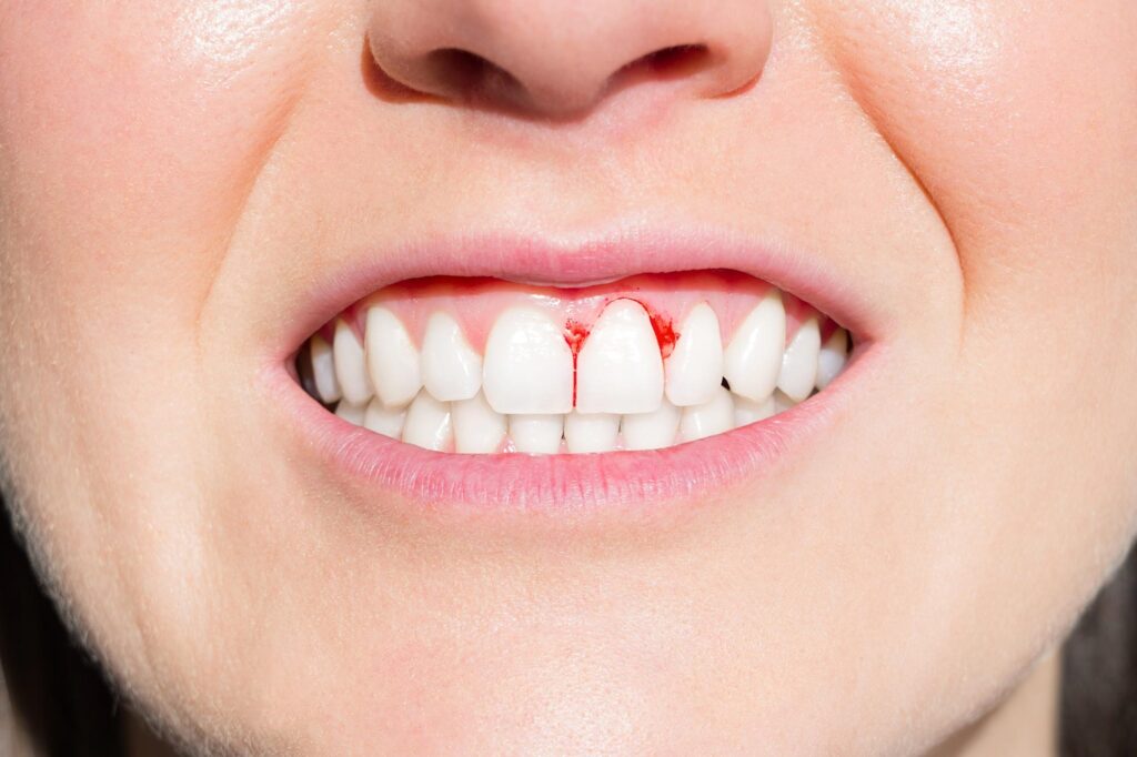 Bleeding-Gums - 7 Signs that indicate something is wrong with your body- by livelovelaugh