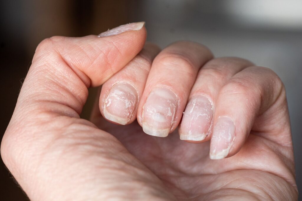 fragile nails - 7 Signs that indicate something is wrong with your body- by livelovelaugh