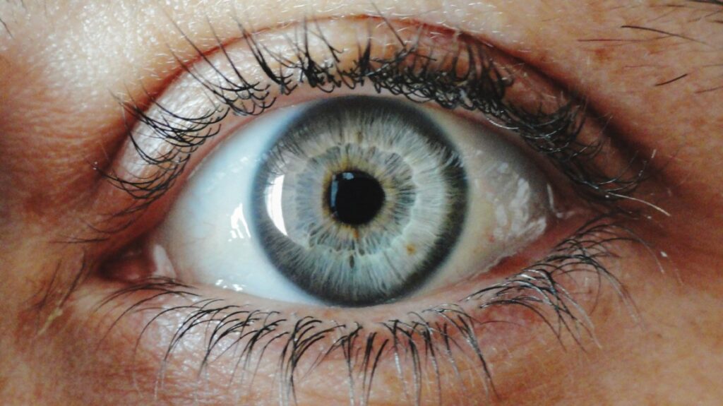rings around the irises - 7 Signs that indicate something is wrong with your body- by livelovelaugh